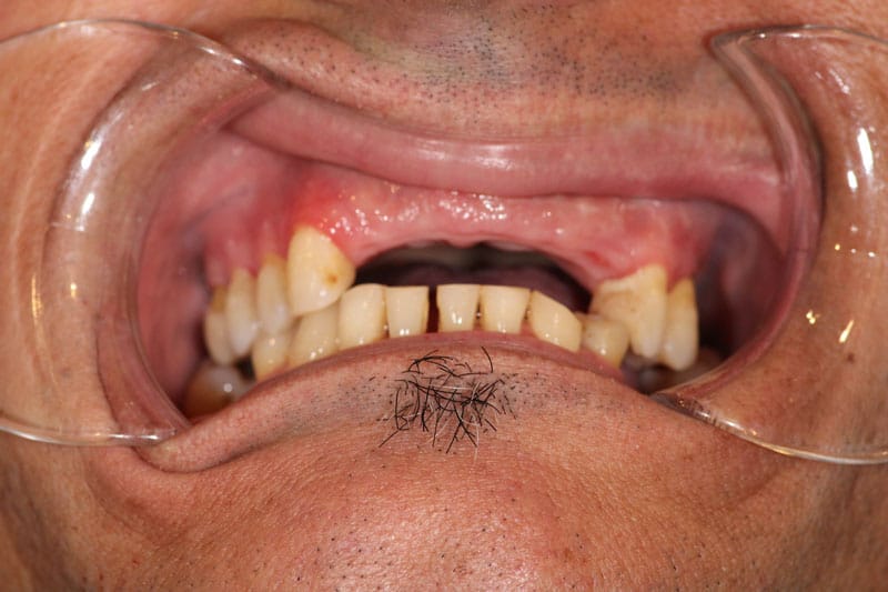 blog implants before